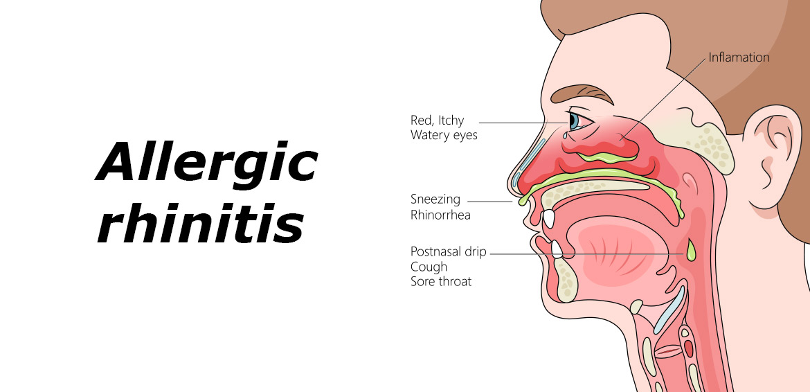 التهاب الأنف التحسسي .. Allergic Rhinitis